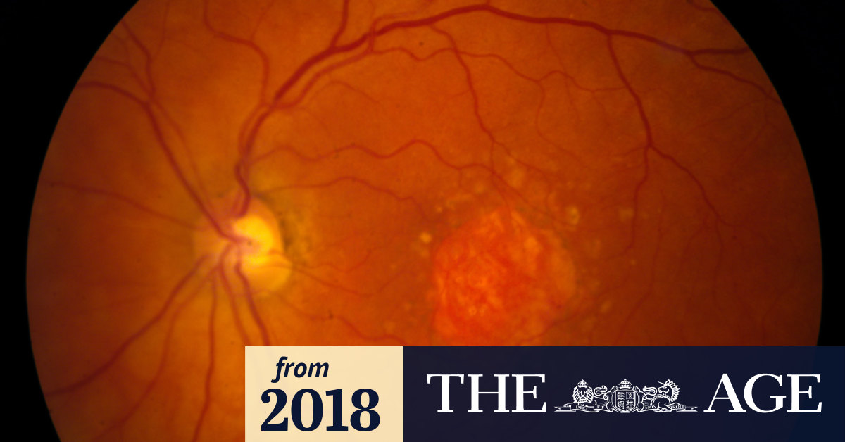 Patients with macular degeneration regain vision in breakthrough study
